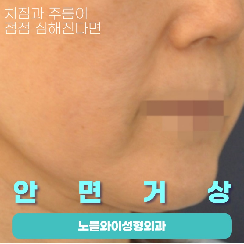  안면거상술 전문병원 정말 맞는건지