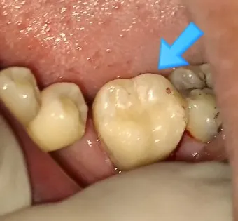 어금니 칫솔 사용법 선택방법 실사용 후기_24