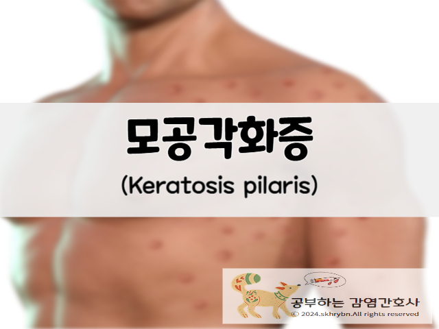 성인간호_모공각화증(keratosis pilaris)원인, 부위, 치료법