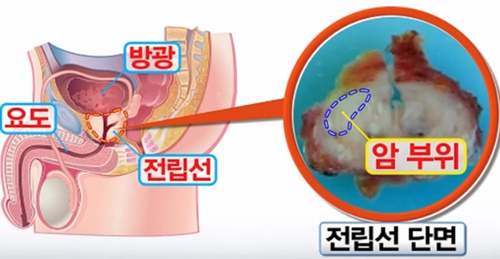  전립선암에 후코이단은 어떤 도움을 주나