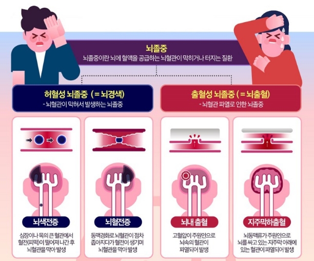 뇌경색 초기증상 원인 자가진단 정보 총정리3