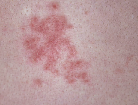 남성의 헤르페스 2형