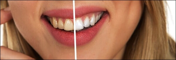 치아-치료-전후-사진