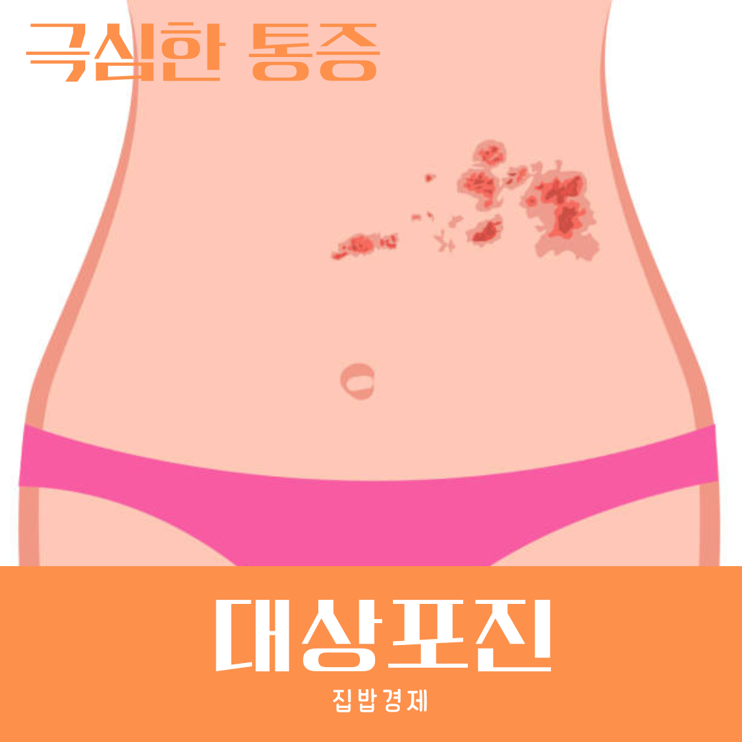 대상포진