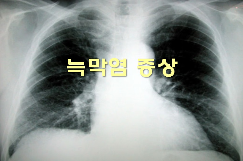  늑막염 증상과 치료 방법