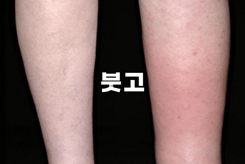  종아리 붓기 pulio