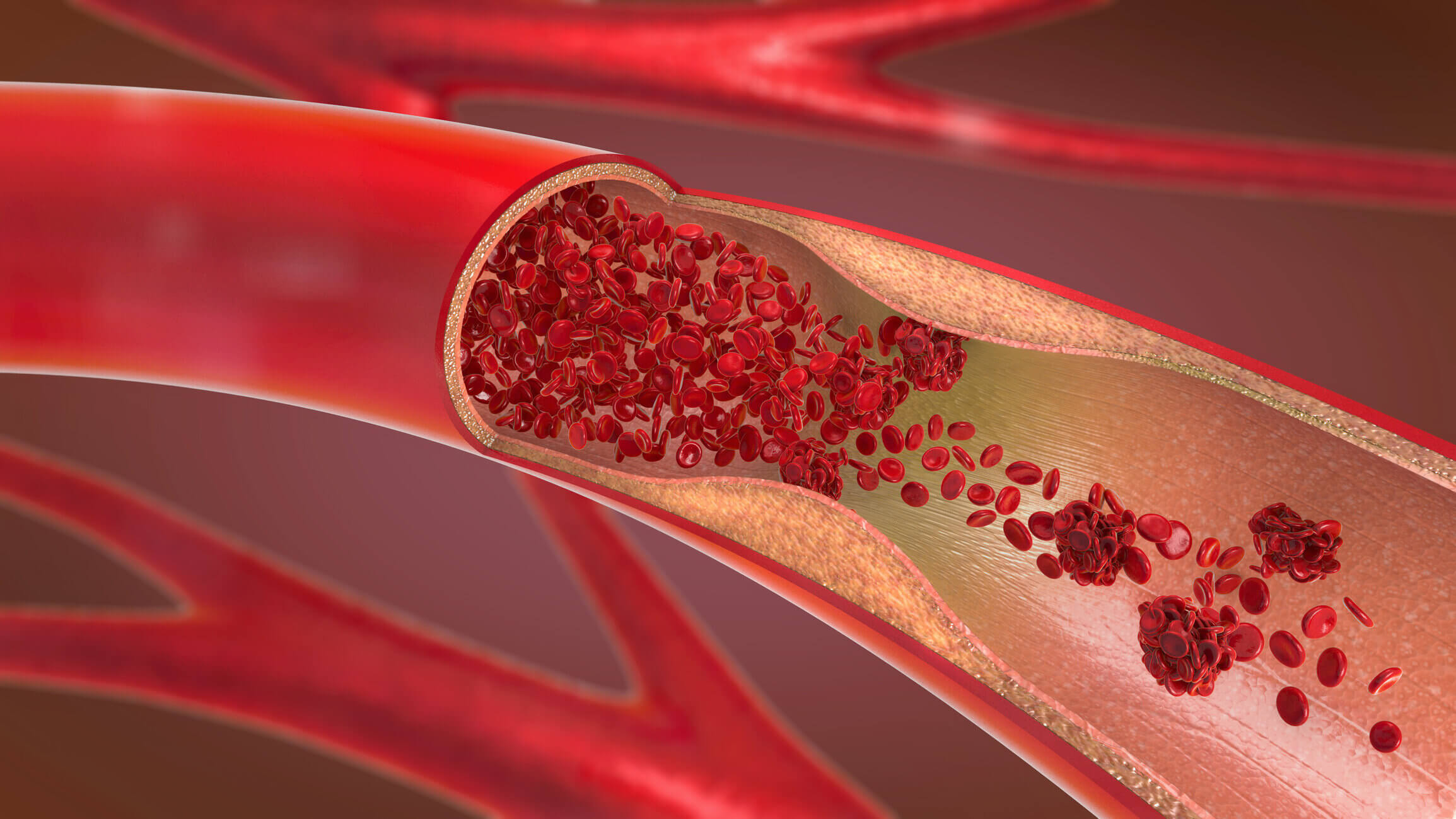 vascular disease