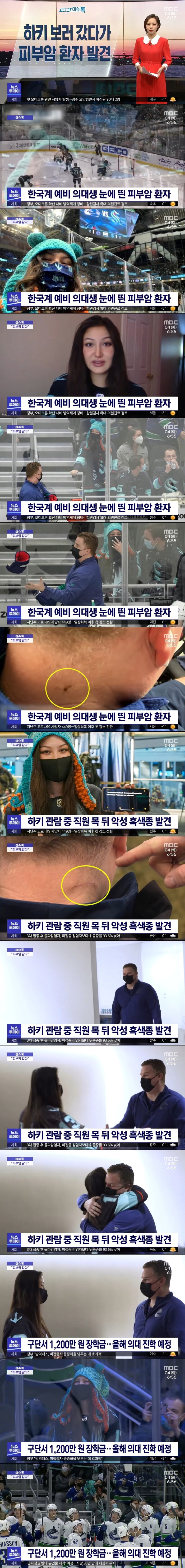  아이스하키보러 갔다가 피부암 환자 발견