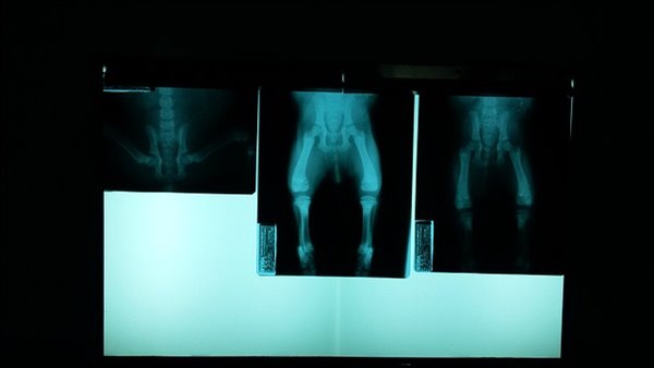 골반-X-ray-사진