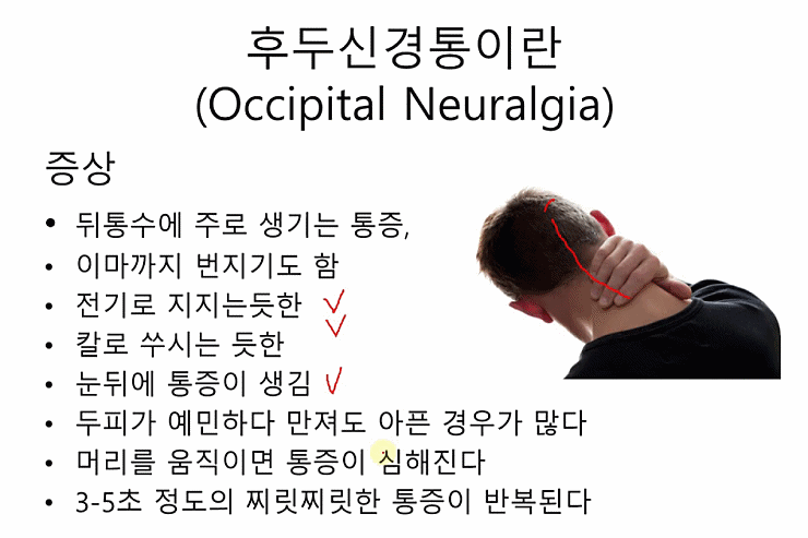 뒷골 땡길때 후두 신경통 의심해 보자 뒷골 땡길때 후두 신경통 의심해 보자