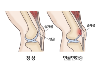 슬개골 연골 연화증