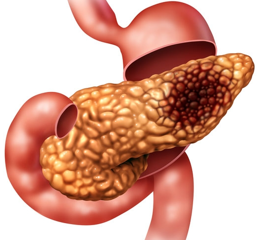 췌장암 원인