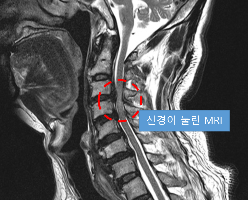 신경이-눌린-것이-확실하게-보이는-MRI-사진