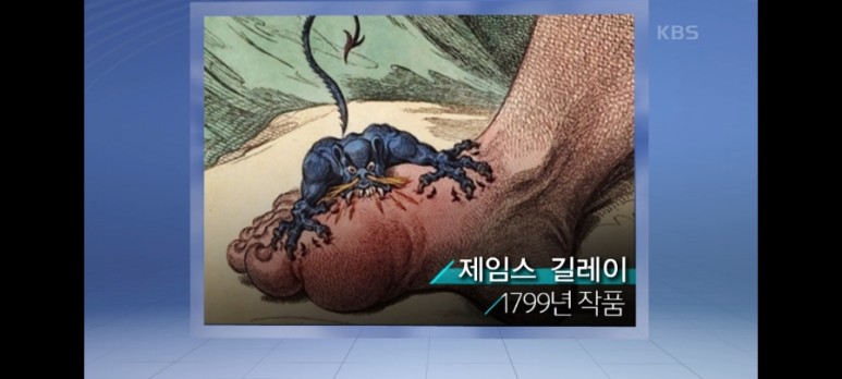 [생로병사의비밀-통풍] 통풍 7