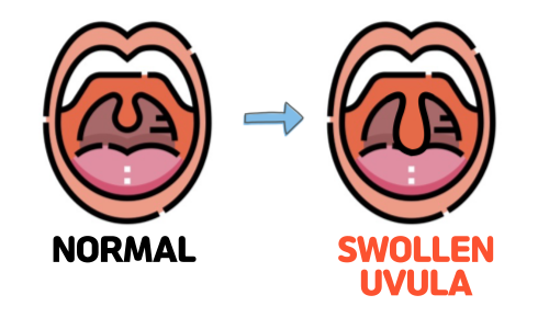 목젖 이물감, 목젖 부음, 목젖 늘어짐 원인과 치료는? (Swollen Uvula)