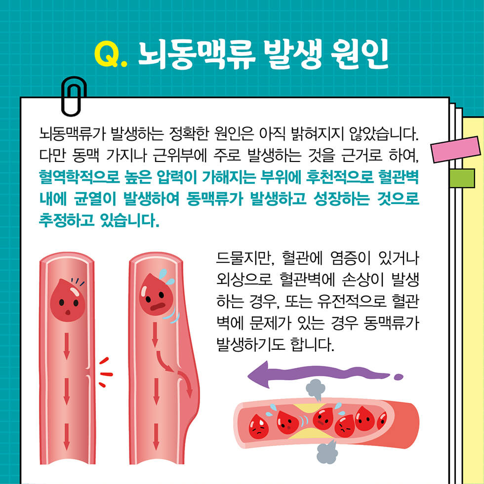 뇌동맥류 총정리 원인 증상 치료법 예방