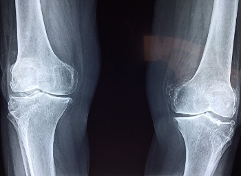 무릎 관절의 x레이 사진