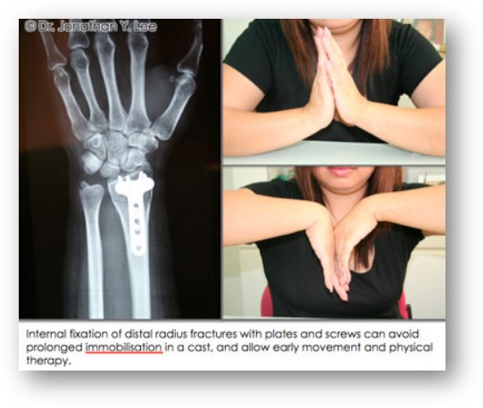 손목 골절후 장애