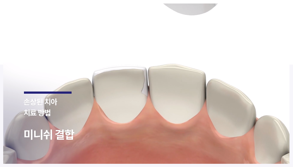미니쉬 치과병원, 미니쉬 가격 아세요 (완벽정리)