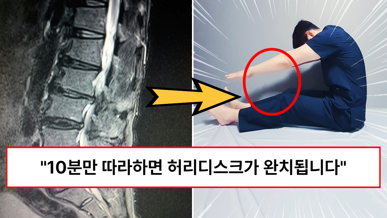 “돈은 전혀 필요하지 않습니다” 이미 다친 디스크도 회복된다는 가장 완벽하게 허리디스크를 완치할 수 있는 방법