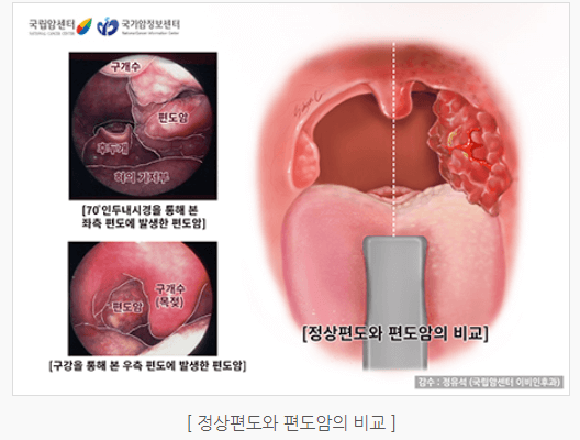 설암 침샘암 편도암 초기증상