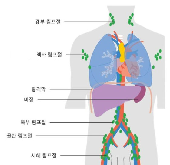  림프종 혈액암 증상, 원인 총정리