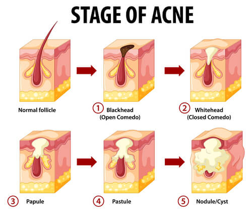 stage-of-acne