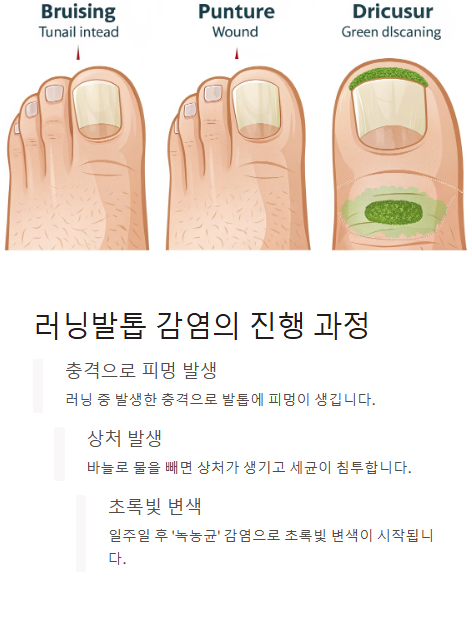 러닝 발톱 감염의 진행 과정