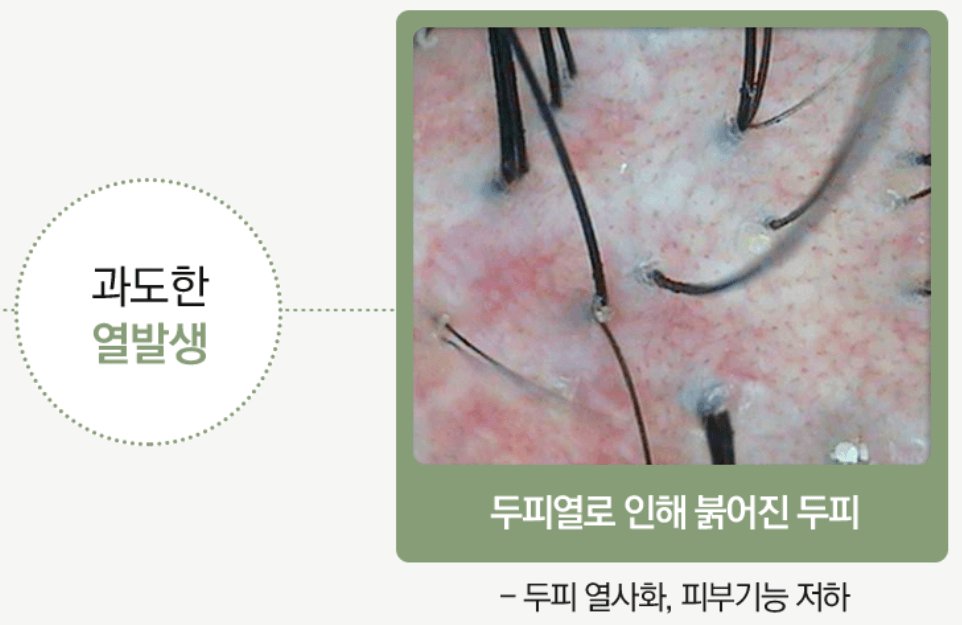 두피 지루성 피부염 치료 병원과 원인