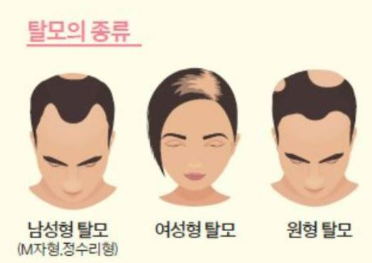 미녹시딜-부작용