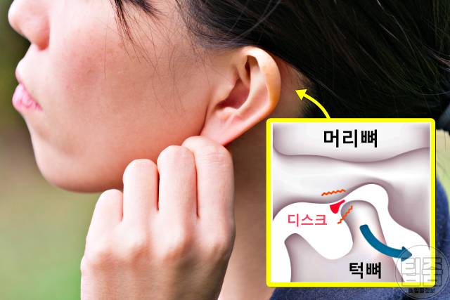 귀에서 삐소리 이명 증상 원인 턱관절 장애