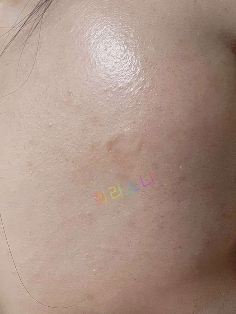 흉터 치료 받고 찍은 경과 사진. 왼쪽 뺨의 1CM 가량 되는 길쭉한 흉터.