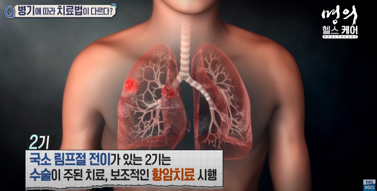 폐암2기 치료방법