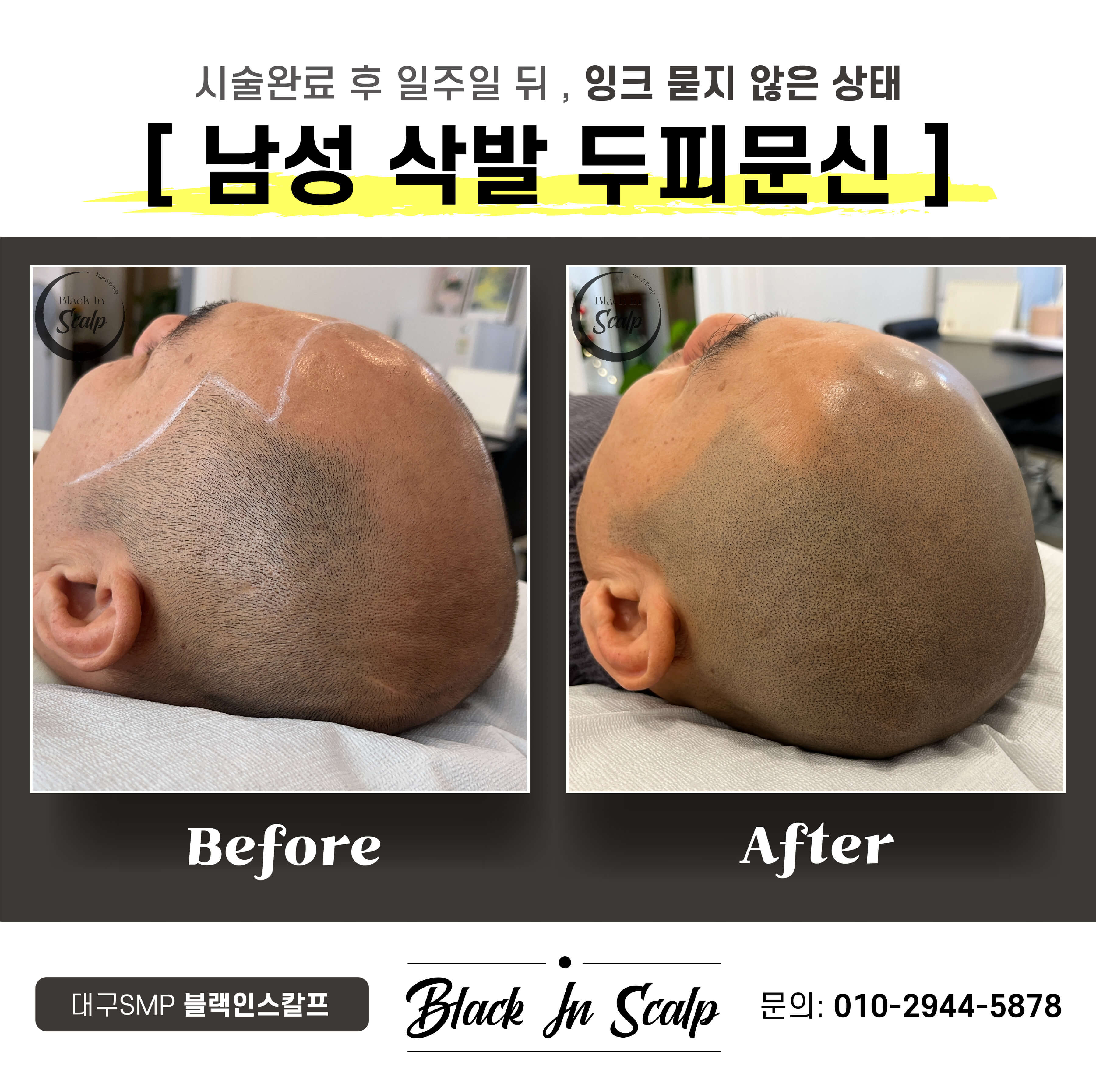 도트인스칼프 이미지