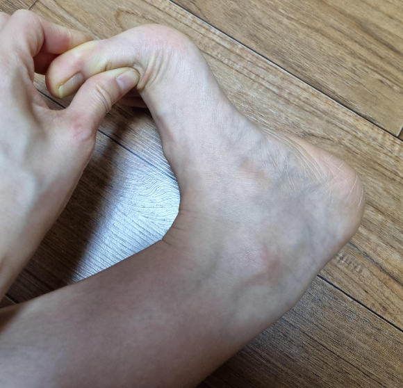 족저근막염 완화를 위한 엄지발가락 신전하여 발바닥을 스트레칭해주는 사진