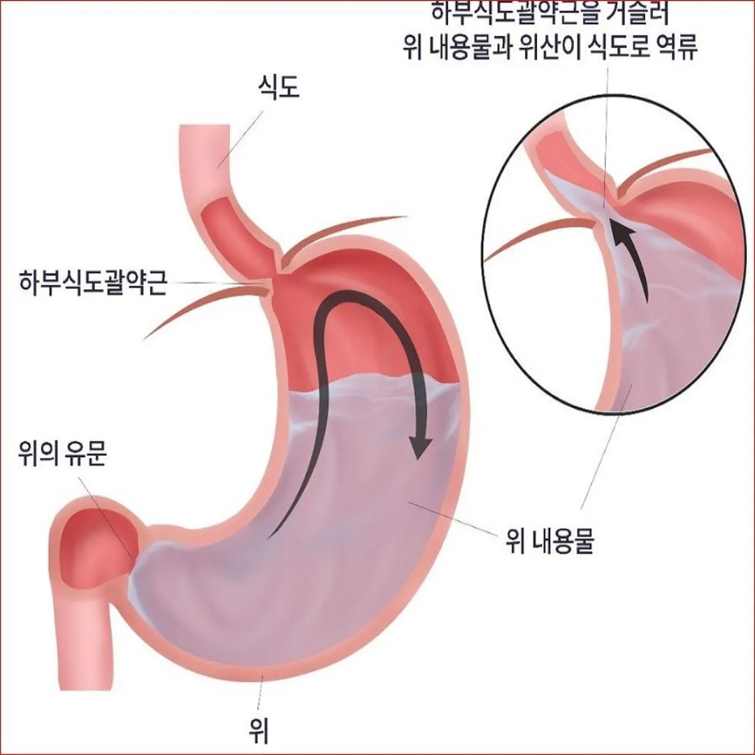 역류성 식도염 증상과 자연치료 방법