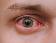 유행성 결막염으로 인해 충혈된 눈을 보여주는 사진