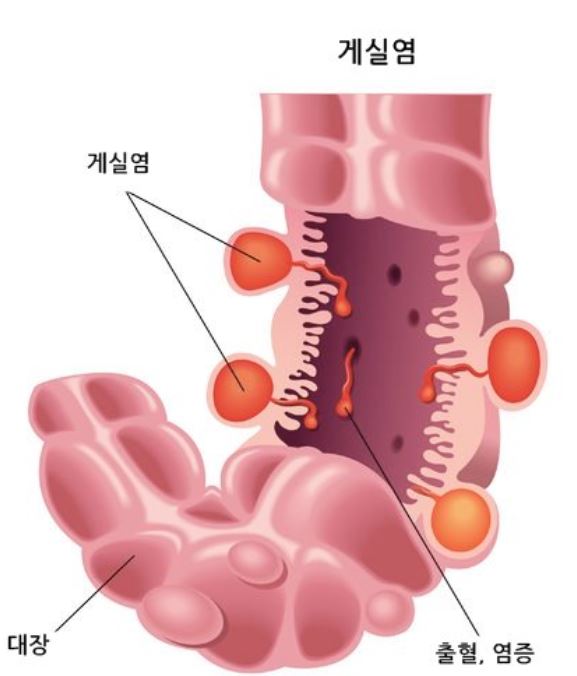 왼쪽-아랫배-통증
