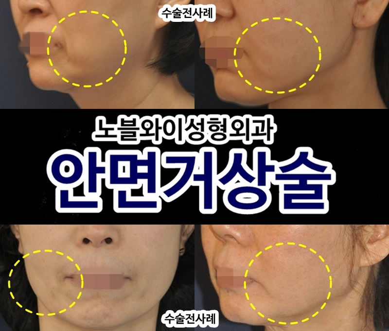  안면거상부작용 이유가 유지인대를 안끊어서?