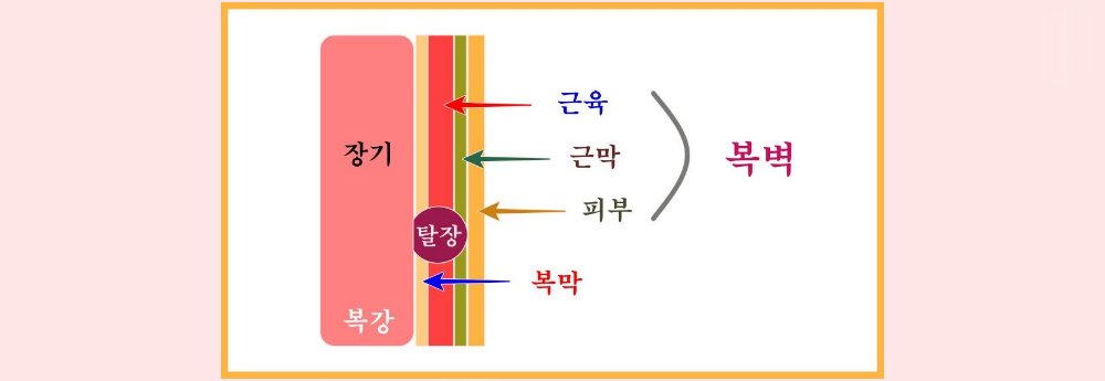 탈장 수술 후기, 서혜부 무인공망 탈장 수술 후기, 서혜부 무인공망