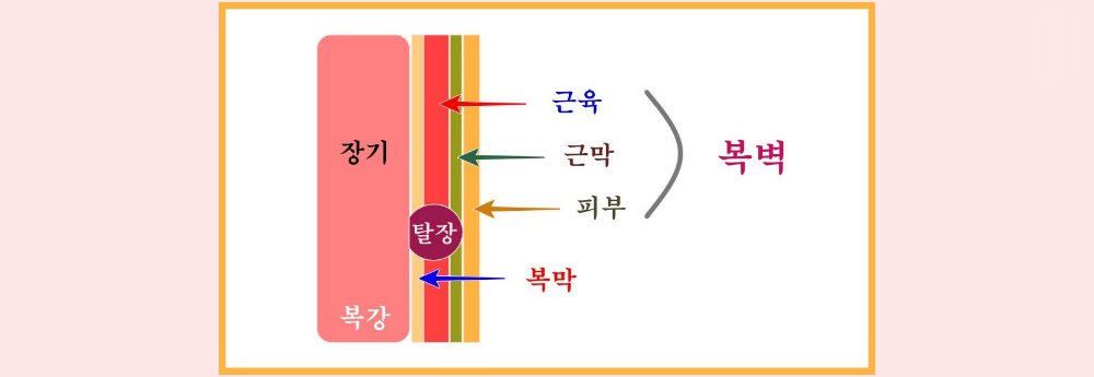 복막-근막-근육-피부-복벽-설명-그림