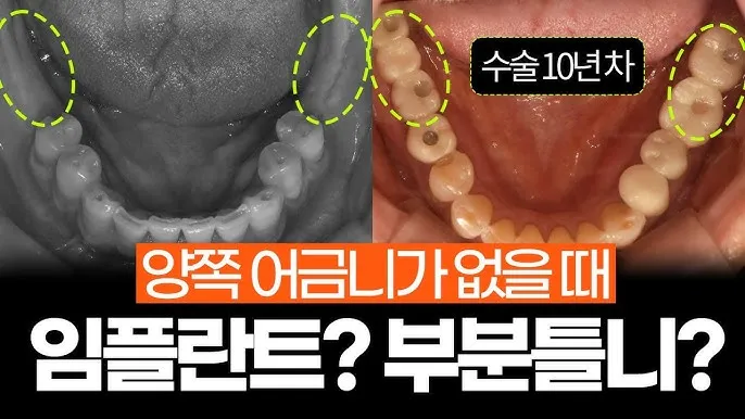 어금니 칫솔 사용법 선택방법 실사용 후기_7