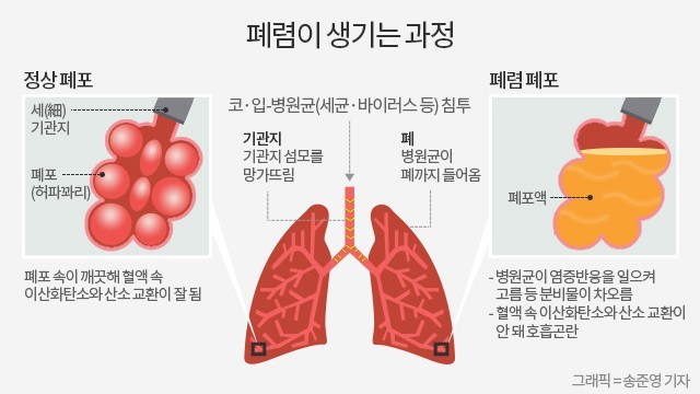 폐렴이 생기는 과정/ 출처 - 네이버블로그[웰빙의 건강 의학 Life Log]