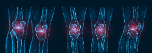 무릎통증과 관절염 