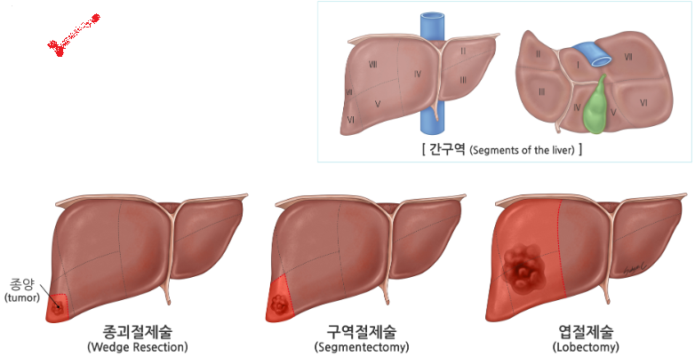 간절제술