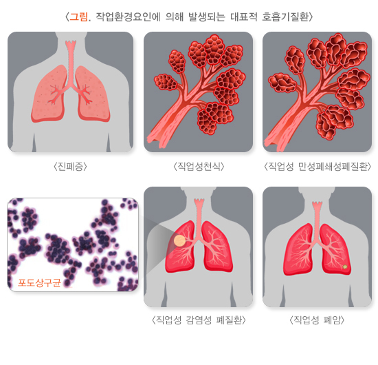  직업성 폐질환