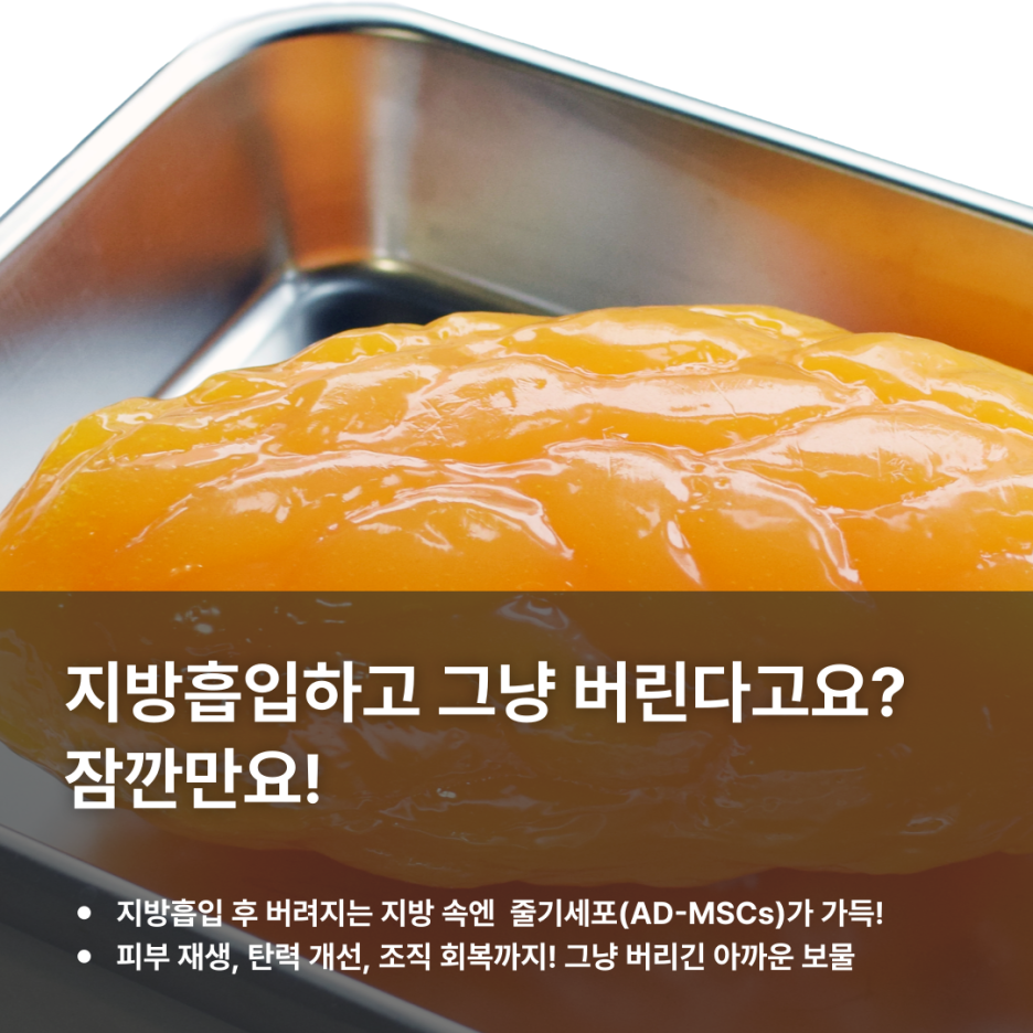 img 지방흡입 후 버려지는 지방, 알고 보니 줄기세포 보물 창고?!