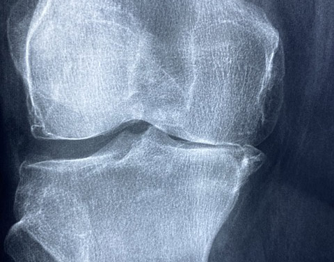 무릎바깥쪽통증 반월상연골판파열