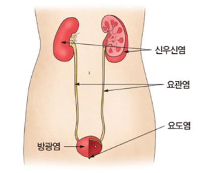  요로감염 증상/원인/치료