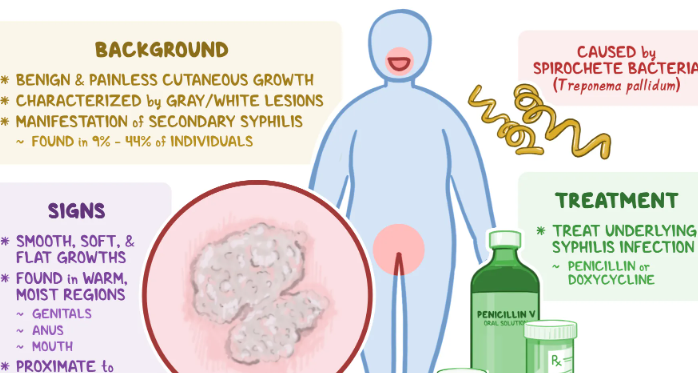  심각한 성병, 곤지름(Condyloma)의 원인과 증상 치료방법 및 예방법